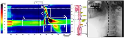 High Resolution Manofluorographic Study in Patients With Multiple System Atrophy: Possible Early Detection of Upper Esophageal Sphincter and Proximal Esophageal Abnormality